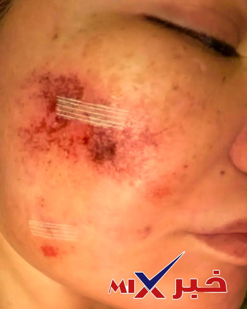 ما-هي-أزمة-ياسمين-الخطيب؟ ما هو مرض ياسمين الخطيب؟ كل ما تريد معرفته عن أسباب الإصابة والعدوى والعلاج ومدة التعافي بالتفصيل 2026